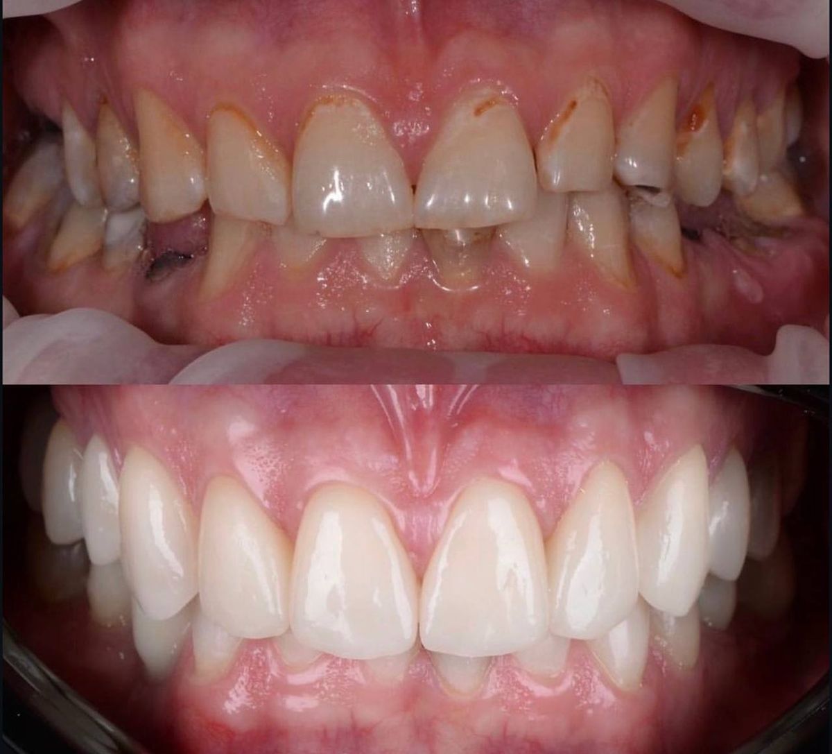 Anterior restoration close-up: before and after