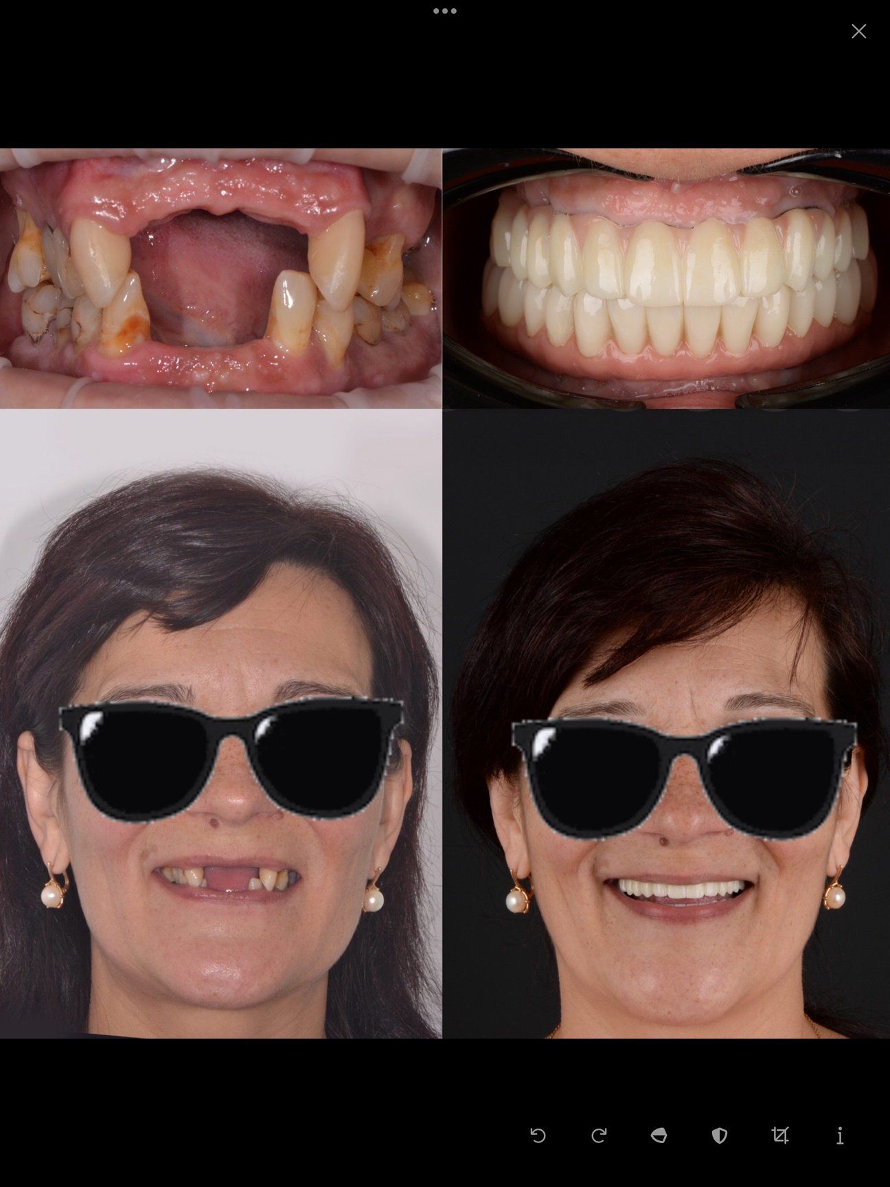 Full-mouth rehabilitation: before and after — implant-supported restorations of both jaws