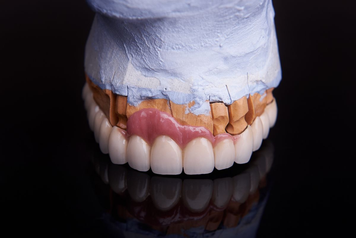 Finished ceramic restoration photographed on the working model in the laboratory