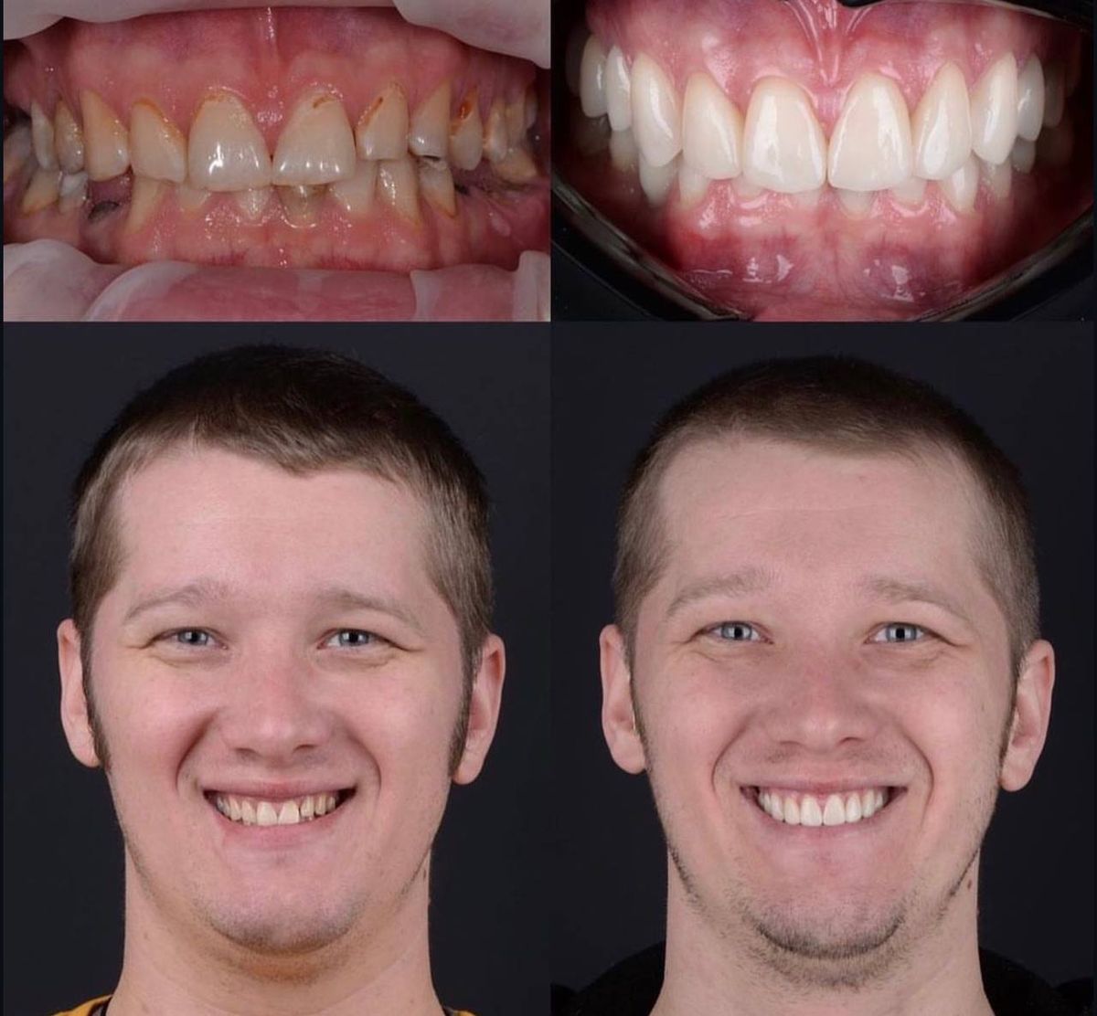 Anterior aesthetic case: before and after smile transformation