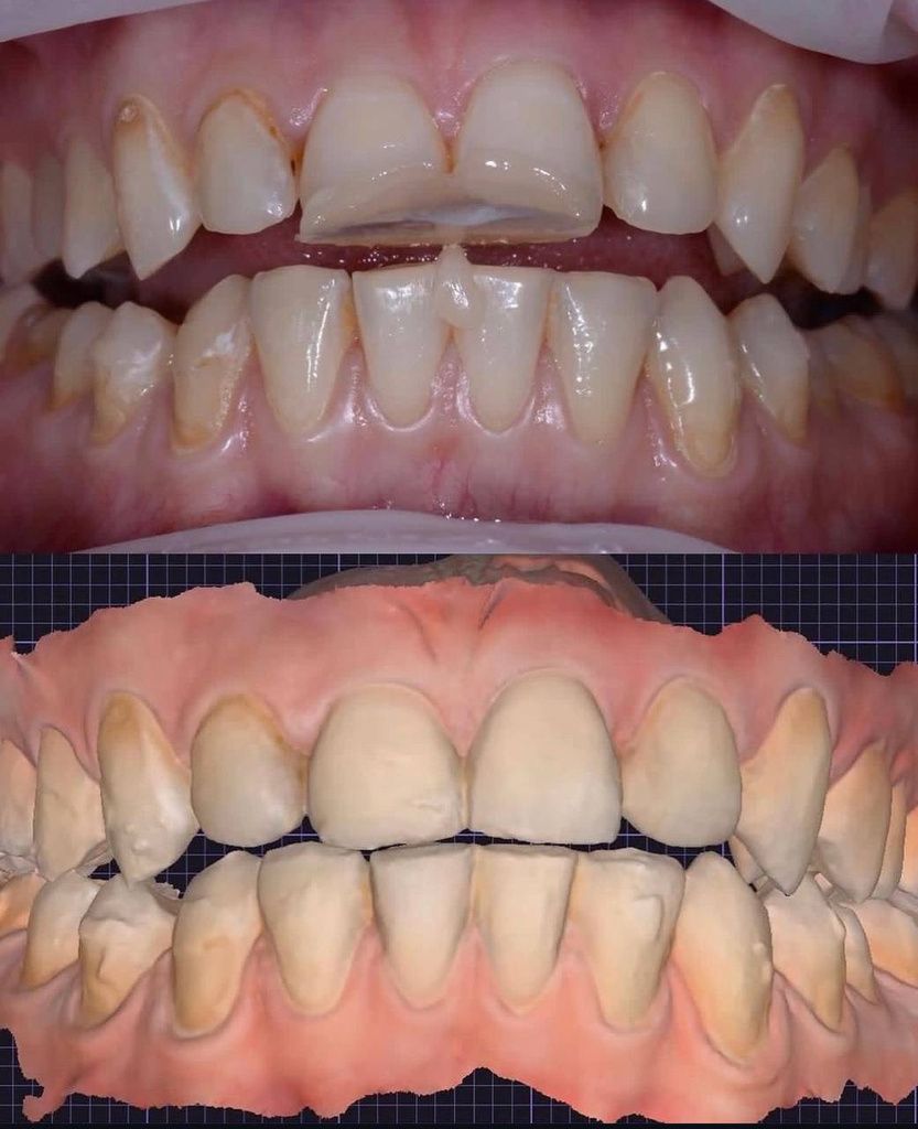 Intraoral photo alongside its digital 3D scan used for CAD design